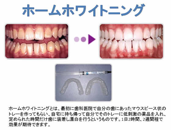 ホワイトニング